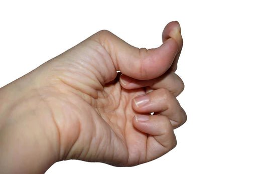 Ehlers-Danlos syndrom (EDF): En förbisedd, kronisk och försvagande bindvävssjukdom - Seniorliving