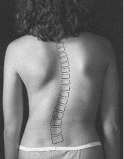 Skolios - Smärtsam, försvagande och kronisk feljustering av ryggraden. - Seniorliving